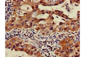 Immunohistochemistry of paraffin-embedded human lung cancer using ABIN7165899 at dilution of 1:100