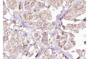 ABIN6275431 at 1/100 staining Human breast cancer tissue by IHC-P.