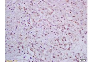 Formalin-fixed and paraffin embedded human gastric carcinoma labeled with Rabbit Anti APC70/CRSP70 Polyclonal Antibody, Unconjugated (ABIN1387561) at 1:200 followed by conjugation to the secondary antibody and DAB staining (CRSP Complex (AA 30-65) anticorps)