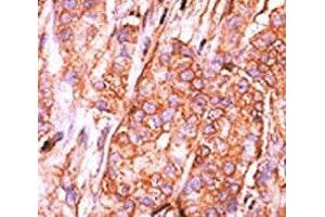 IHC analysis of FFPE human breast carcinoma tissue stained with the CTDSP2 antibody