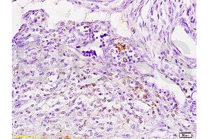 Formalin-fixed and paraffin embedded human breast carcinoma tissue labeled with Anti-Cathepsin H Polyclonal Antibody, Unconjugated (ABIN732758) at 1:200 followed by conjugation to the secondary antibody, (SP-0023), and DAB staining (Cathepsin H anticorps  (AA 71-170))