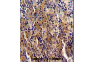 SYNE3 antibody immunohistochemistry analysis in formalin fixed and paraffin embedded human hodgkin lymphoma followed by peroxidase conjugation of the secondary antibody and DAB staining.