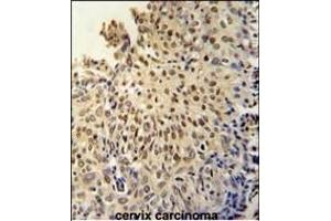 DI3L1 Antibody (N-term) (ABIN651802 and ABIN2840405) immunohistochemistry analysis in formalin fixed and paraffin embedded human cervix carcinoma followed by peroxidase conjugation of the secondary antibody and DAB staining. (DIS3L anticorps  (N-Term))