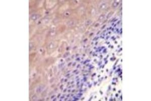 Immunohistochemistry analysis in formalin fixed and paraffin embedded human esophageal carcinoma reacted with GCLC / GLCLC Antibody (N-term) followed by peroxidase conjugation of the secondary antibody and DAB staining