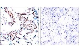 Immunohistochemistry analysis of paraffin-embedded human breast carcinoma tissue, using c-Jun (Ab-170) Antibody. (C-JUN anticorps  (AA 137-186))