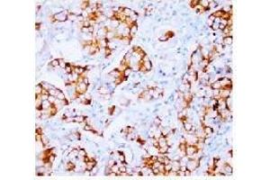 Immunohistochemical analysis of Paraffin Embeedded Mammary cancer sections using FGF2 antibody. (FGF2 anticorps  (N-Term))