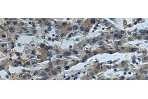 Immunohistochemistry of paraffin-embedded Human liver cancer tissue using CUL5 Polyclonal Antibody at dilution of 1:55(x200) (Cullin 5 anticorps)