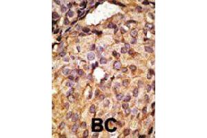 Formalin-fixed and paraffin-embedded human cancer tissue reacted with Tlr6 polyclonal antibody  , which was peroxidase-conjugated to the secondary antibody, followed by AEC staining. (TLR6 anticorps  (C-Term))