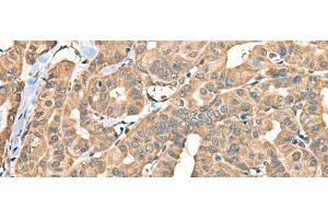 Immunohistochemistry of paraffin-embedded Human thyroid cancer tissue using FAM110B Polyclonal Antibody at dilution of 1:40(x200) (FAM110B anticorps)