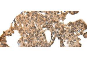 Immunohistochemistry of paraffin-embedded Human thyroid cancer tissue using APC Polyclonal Antibody at dilution of 1:45(x200) (APC anticorps)
