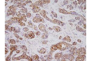 Immunohistochemistry of human breast carcinoma tissues were incubated with TPD52L1 monoclonal antibody , clone d1C5 (1 : 200)  at room temperature. (TPD52L1 anticorps  (AA 1-131))