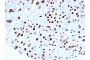 Formalin fixed paraffin embedded human colon carcinoma stained with p21 Recombinant Mouse Monoclonal Antibody (rCIP1/6907) at 2 μg/mL.