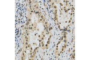 Immunohistochemical analysis of JUNB staining in human lung cancer formalin fixed paraffin embedded tissue section. (JunB anticorps)