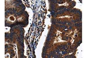 The image on the left is immunohistochemistry of paraffin-embedded Human colon cancer tissue using ABIN7191225(KLHL8 Antibody) at dilution 1/20, on the right is treated with synthetic peptide. (KLHL8 anticorps)