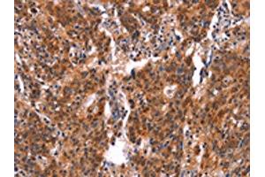 The image on the left is immunohistochemistry of paraffin-embedded Human gastric cancer tissue using ABIN7190641(FEM1A Antibody) at dilution 1/20, on the right is treated with synthetic peptide. (FEM1A anticorps)