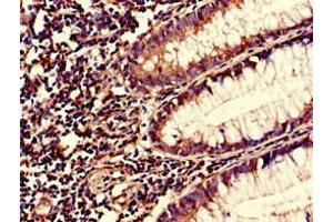 Immunohistochemistry of paraffin-embedded human colon cancer using ABIN7166034 at dilution of 1:100 (S1A1 (AA 2-97) anticorps)