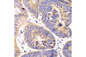 Immunohistochemistry of paraffin-embedded human colon carcinoma using HMGCL antibody. (HMGCL anticorps  (AA 1-325))