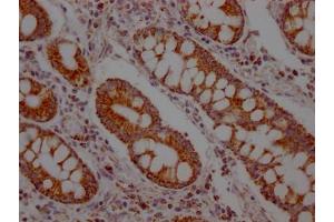 IHC image of ABIN7127629 diluted at 1:100 and staining in paraffin-embedded human colon cancer performed on a Leica BondTM system. (Recombinant SLC16A1 anticorps)