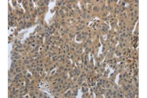 The image on the left is immunohistochemistry of paraffin-embedded Human ovarian cancer tissue using ABIN7192074(PTPRT Antibody) at dilution 1/30, on the right is treated with synthetic peptide.