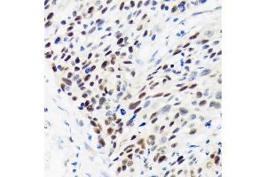 Immunohistochemistry of paraffin-embedded Human esophageal cancer using WDHD1 Rabbit pAb (ABIN7271351) at dilution of 1:100 (40x lens). (WDHD1 anticorps  (AA 830-1129))