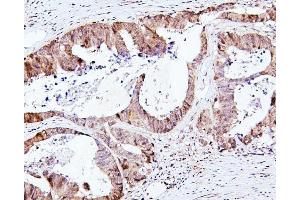 IHC analysis of SMAD2 using anti-SMAD2 antibody (ABIN6719361). (SMAD2 anticorps  (AA 83-264))