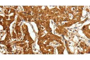 Immunohistochemistry of paraffin-embedded Human lung cancer using Otocadherin Polyclonal Antibody at dilution of 1:80 (CDH23 anticorps)