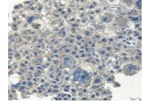 Detection of MYH14 in Human Liver Cancer Tissue using Polyclonal Antibody to Myosin Heavy Chain 14, Non Muscle (MYH14) (Myosin anticorps  (AA 1069-1331))