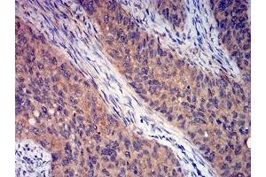 Immunohistochemical analysis of paraffin-embedded cervical cancer tissues using GRM3 mouse mAb with DAB staining. (Metabotropic Glutamate Receptor 3 anticorps  (AA 433-576))