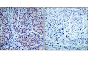 Immunohistochemistry analysis of paraffin-embedded human breast carcinoma tissue, using HDAC2 (Ab-394) Antibody.