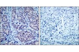 Immunohistochemistry analysis of paraffin-embedded human breast carcinoma tissue, using HDAC2 (Ab-394) Antibody. (HDAC2 anticorps  (AA 360-409))