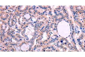 Immunohistochemistry of paraffin-embedded Human thyroid cancer tissue using LEP Polyclonal Antibody at dilution 1:30 (Leptin anticorps)