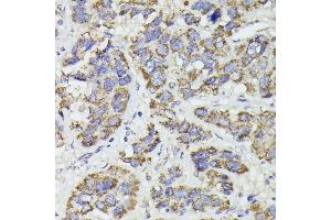 Immunohistochemistry of paraffin-embedded human liver cancer using SUCLG2 antibody  at dilution of 1:100 (40x lens).