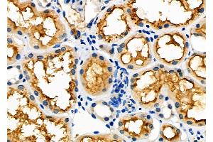 ABIN6265906 and ABIN6277616 at 1/100 staining Human kidney cancer and adjacent normal tissues by IHC-P.