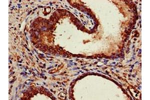 Immunohistochemistry of paraffin-embedded human prostate cancer using ABIN7150624 at dilution of 1:100 (Mre11 anticorps  (AA 1-205))