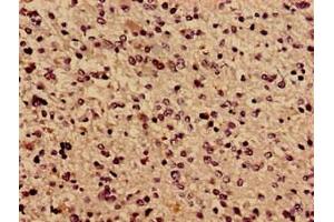 Immunocytochemistry analysis of human glioma using ABIN7171638 at dilution of 1:100 (TBC1D31 anticorps  (AA 662-1001))