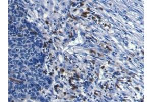 Detection of S100A8 in Human Ovarian cancer Tissue using Monoclonal Antibody to S100 Calcium Binding Protein A8 (S100A8)