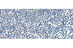 Immunohistochemistry of paraffin-embedded Human tonsil tissue using KIF2A Polyclonal Antibody at dilution of 1:65(x200) (KIF2A anticorps)
