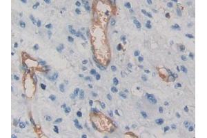 DAB staining on IHC-P; Samples: Human Glioma Tissue) (VEGFA anticorps  (AA 28-147))