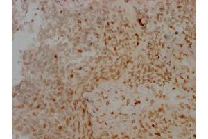 IHC image of ABIN7127357 diluted at 1:100 and staining in paraffin-embedded human cervical cancer performed on a Leica BondTM system.