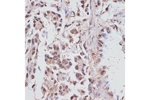 Immunohistochemistry of paraffin-embedded human lung cancer using RP/RP/RP antibody (ABIN6128653, ABIN6147083, ABIN6147084 and ABIN6214011) at dilution of 1:100 (40x lens).