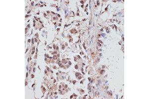 Immunohistochemistry of paraffin-embedded human lung cancer using RP/RP/RP antibody (ABIN6128653, ABIN6147083, ABIN6147084 and ABIN6214011) at dilution of 1:100 (40x lens). (RPA1 anticorps  (AA 1-240))