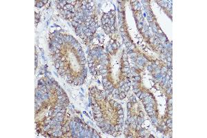 Immunohistochemistry of paraffin-embedded human colon carcinoma using  Rabbit pAb (ABIN7265359) at dilution of 1:50 (40x lens).