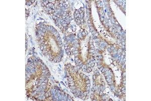Immunohistochemistry of paraffin-embedded human colon carcinoma using  Rabbit pAb (ABIN7265359) at dilution of 1:50 (40x lens). (ABI1 anticorps  (AA 180-230))