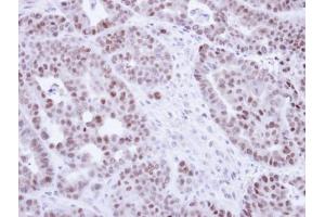 IHC-P Image Immunohistochemical analysis of paraffin-embedded NCIN87 Xenograft, using NR2C2, antibody at 1:100 dilution. (TR4 anticorps)