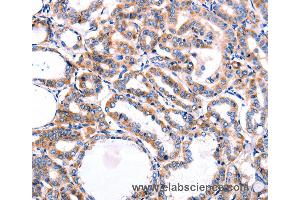Immunohistochemistry of Human thyroid cancer using HDAC7 Polyclonal Antibody at dilution of 1:5 (HDAC7 anticorps)
