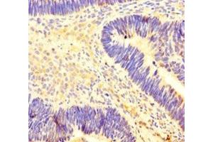 Immunohistochemistry of paraffin-embedded human ovarian cancer using ABIN7155449 at dilution of 1:100