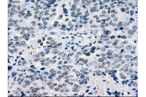 Immunohistochemical staining of paraffin-embedded Adenocarcinoma of colon tissue using anti-CRYABmouse monoclonal antibody. (CRYAB anticorps)