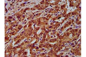 IHC image of ABIN7148830 diluted at 1:200 and staining in paraffin-embedded human liver cancer performed on a Leica BondTM system. (GARP anticorps  (AA 131-253))