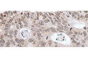 Immunohistochemistry of paraffin-embedded Human colorectal cancer tissue using HIST1H3A Polyclonal Antibody at dilution of 1:35(x200) (HIST1H3A anticorps)