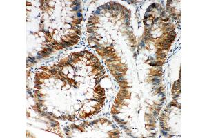 Anti-SQSTM1/p62 antibody, IHC(P) IHC(P): Human Intestinal Cancer Tissue